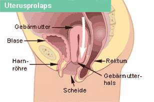Gebärmutterentfernung schonung bauchschnitt nach Gebärmutterentfernung durch