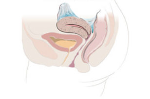 Schwere Endometriose Schwere Endometriose