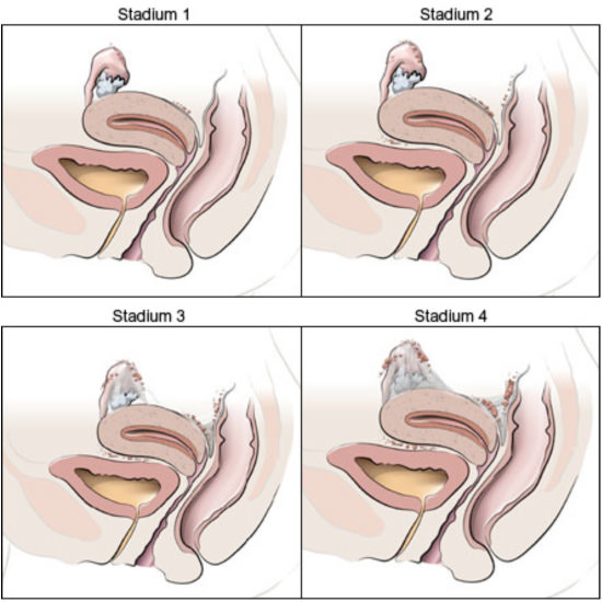 Stadien der Endometriose Stadien der Endometriose