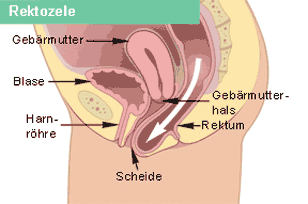 Rektozele (Senkung des Mastdarms)