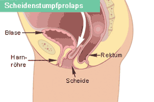 Scheidenstumpfprolaps (Senkung des Scheidenstumpfes nach einer Totaloperation)