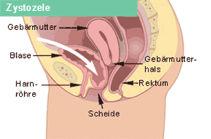 Zystozele (Senkung der Blase)